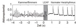 Ein flimmerndes Herz findet durch fünf schnell aufeinanderfolgende schwache Stromschläge (grau dargestellt) in seinen normalen Rhythmus zurück.